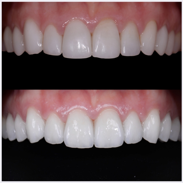 01-full-arch-porcelain-reconstruction