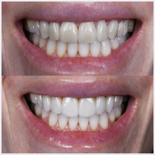 02-full-arch-porcelain-reconstruction