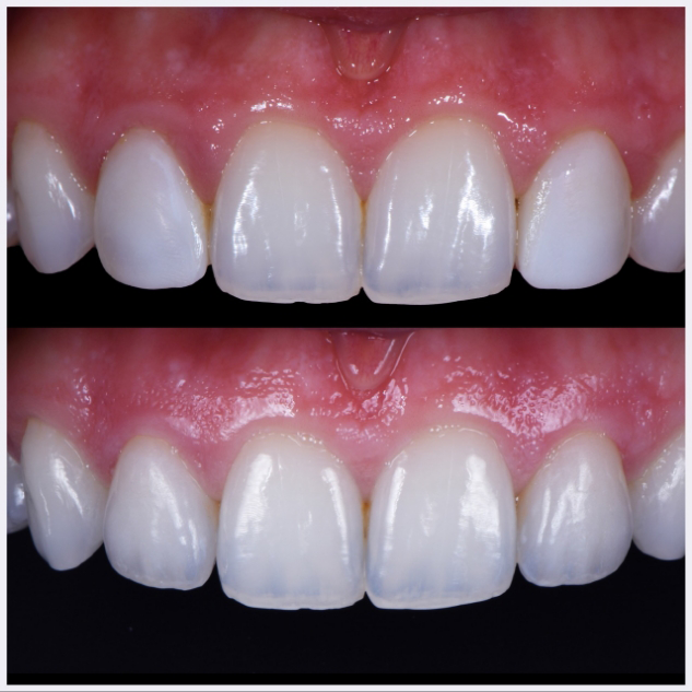 04-single-porcelain-veneers