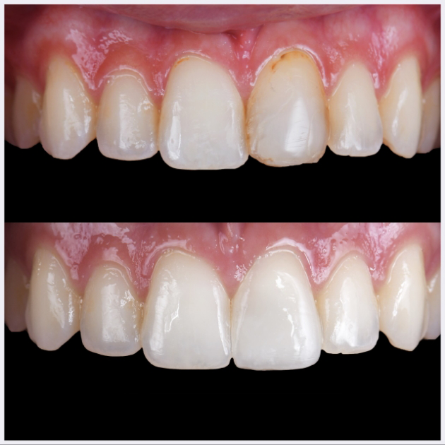 05-single-anterior-direct-composite