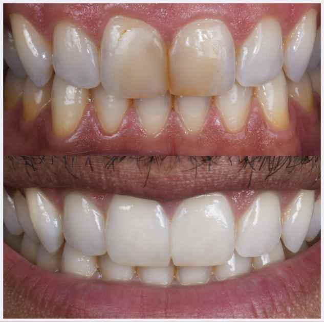 06-2-anterior-direct-composites
