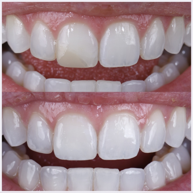 08-single-direct-anterior-composte