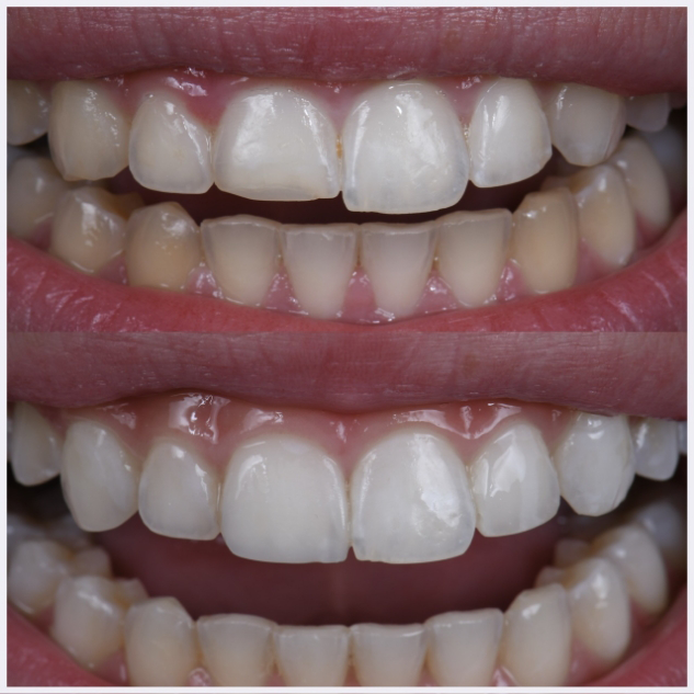10-anteriro-direct-composite-bondings