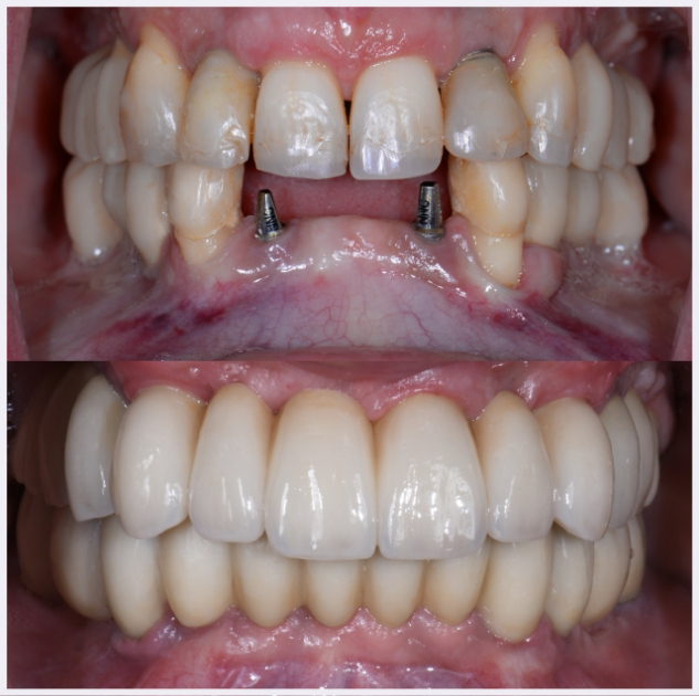 11-full-mouht-rehabilitation-implants-and-crowns