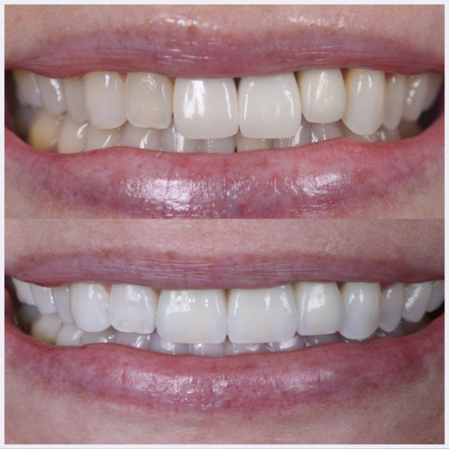12-anterior-implants-and-veneers