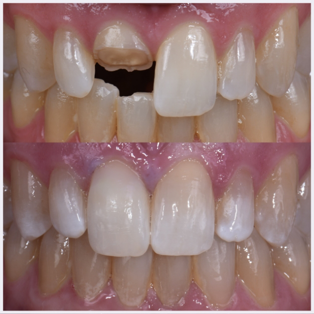13-tooth-reattachment