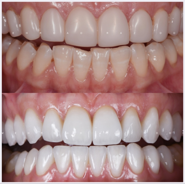 14-full-mouth-rehab