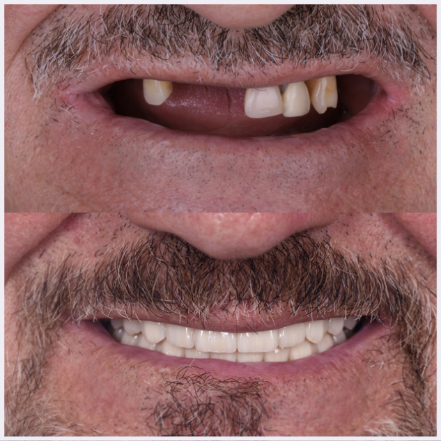15-full-mouth-rehab-(-implants-all-on-X-)