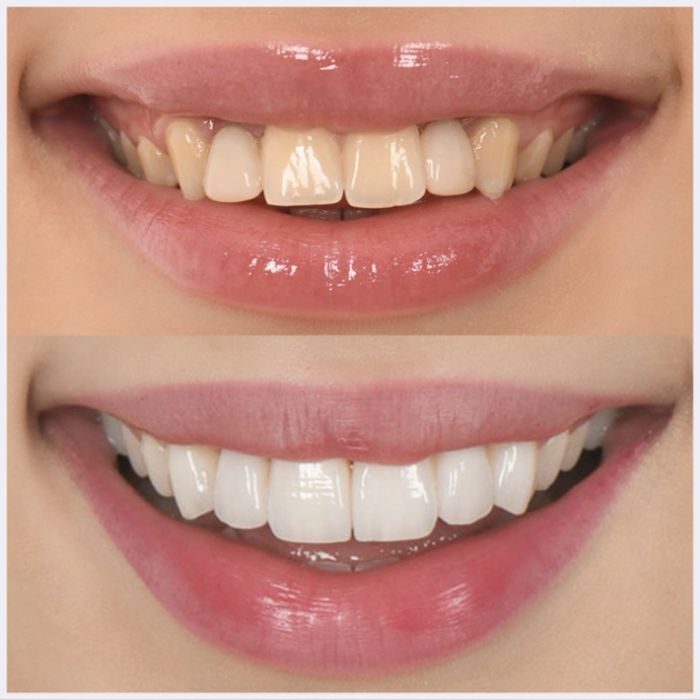 16-maryland-bridges-+-veneers-(-combo-)