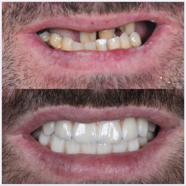 17-full-mouth-rehab-(-all-on-X-)