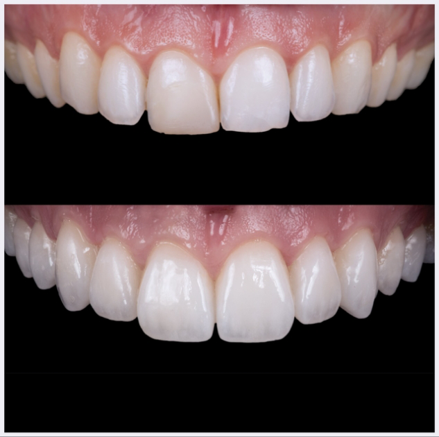 18-upper-porcelain-veneers