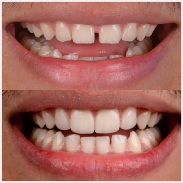 19-upper-anterior-composite-bondings