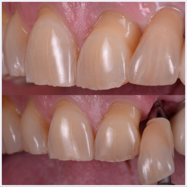 20-single-anteriro-implant