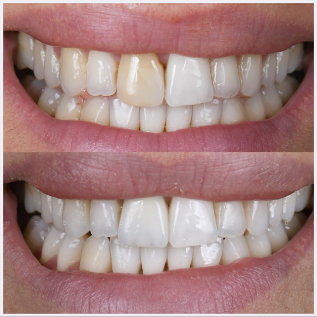 22-single-anterior-crown
