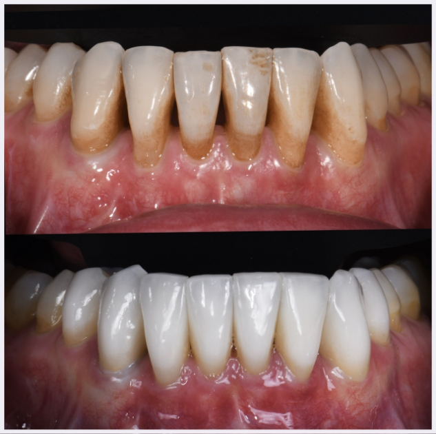 23-lower-arch-gap-closure-porcelain-veneers
