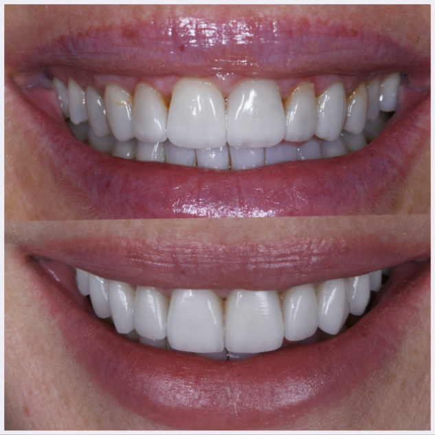 24-upper-veneer-replacement