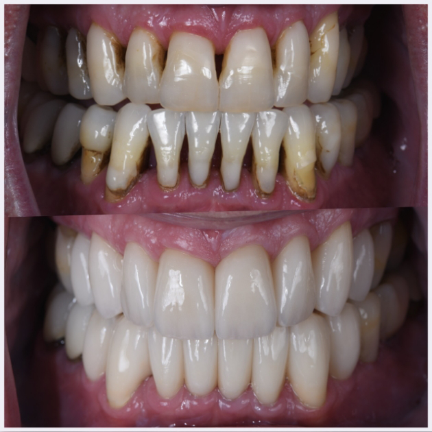 25-full-mouth-rehab-(-gap-closure-porcelain-veneers-)